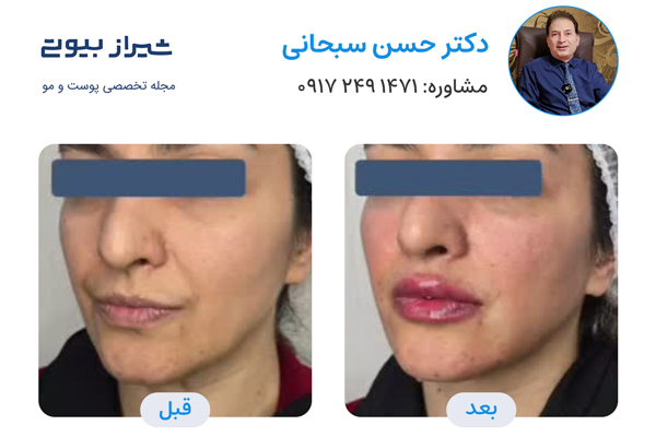 تزریق ژل در شیراز - دکتر حسن سبحانی