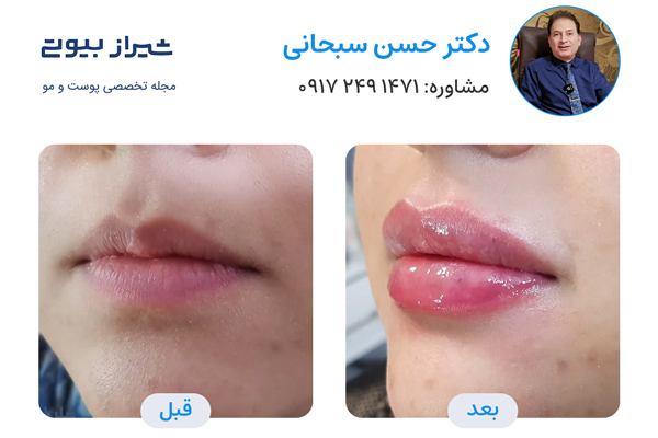 تزریق ژل در شیراز - دکتر حسن سبحانی