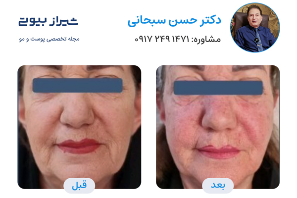 تزریق ژل در شیراز - دکتر حسن سبحانی