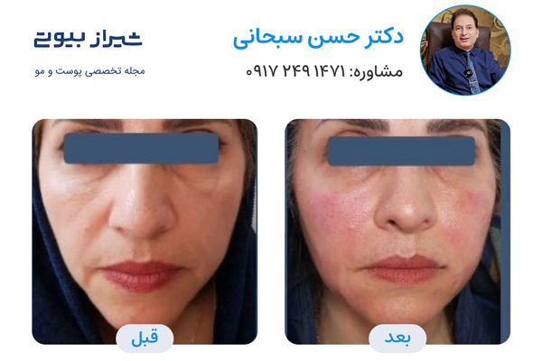 تزریق ژل در شیراز - دکتر حسن سبحانی