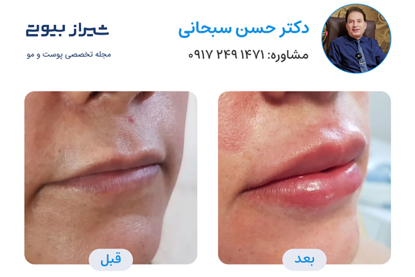 تزریق ژل در شیراز - دکتر حسن سبحانی
