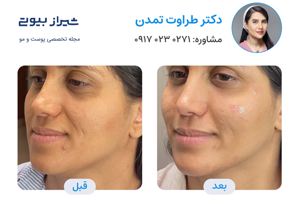 تزریق ژل در شیراز - دکتر طراوت تمدن