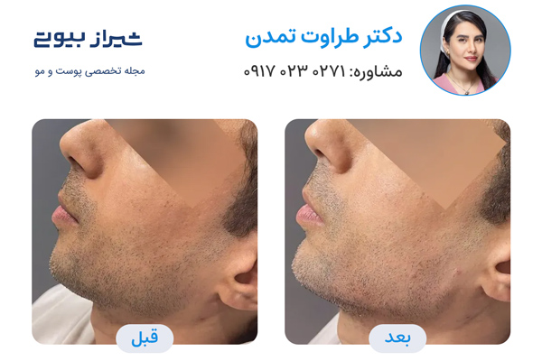 تزریق ژل در شیراز - دکتر طراوت تمدن
