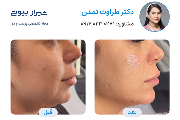 تزریق ژل در شیراز - دکتر طراوت تمدن