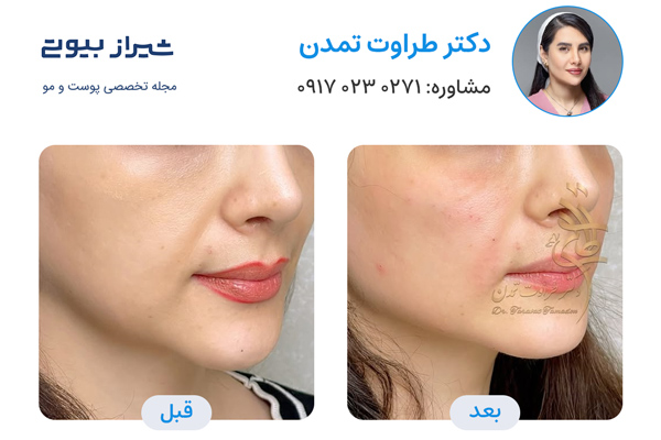 تزریق ژل در شیراز - دکتر طراوت تمدن
