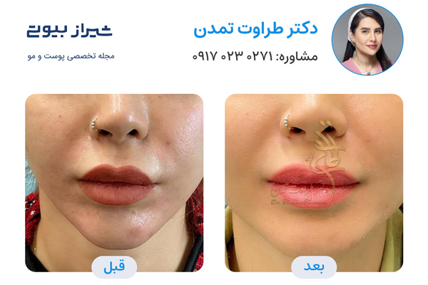 تزریق ژل در شیراز - دکتر طراوت تمدن
