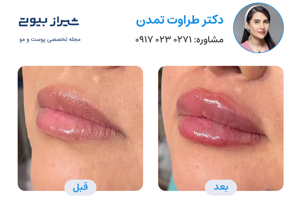 تزریق ژل در شیراز - دکتر طراوت تمدن