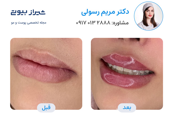 تزریق ژل در شیراز - دکتر مریم رسولی