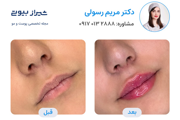 تزریق ژل در شیراز - دکتر مریم رسولی