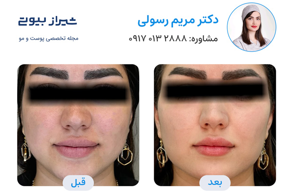 تزریق ژل در شیراز - دکتر مریم رسولی