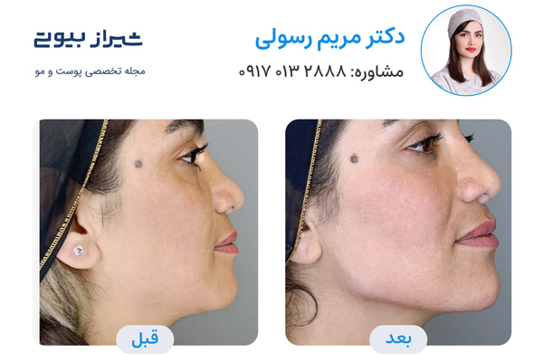 تزریق ژل در شیراز - دکتر مریم رسولی