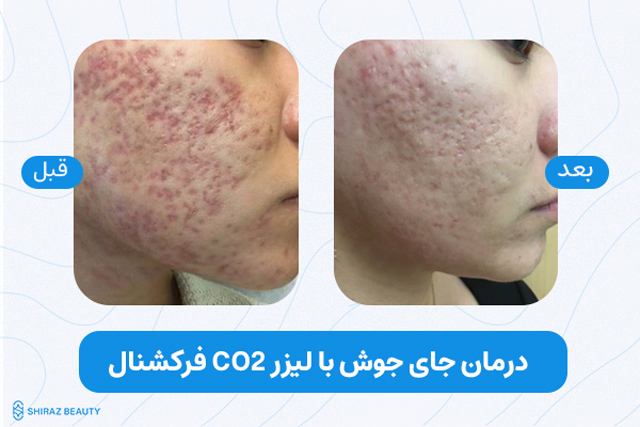 درمان جای جوش با لیزر co2 فراکشنال در شیراز