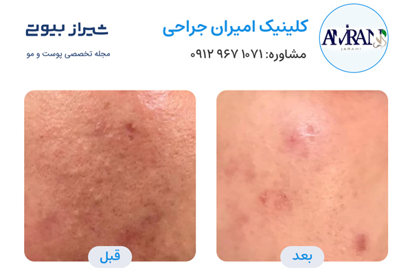 لیزر جای جوش در شیراز - کلینیک امیران جراحی