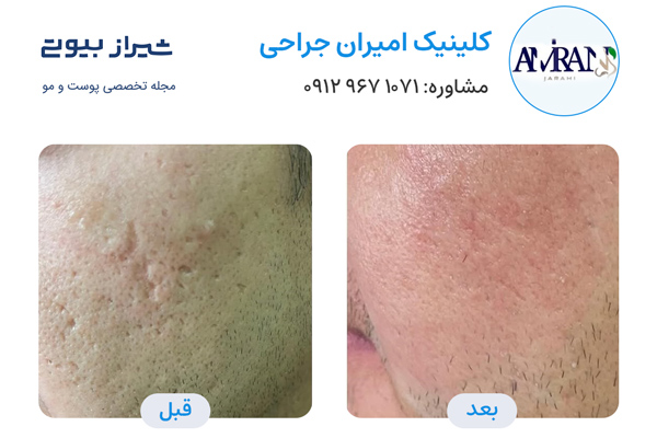 لیزر جای جوش در شیراز - کلینیک امیران جراحی