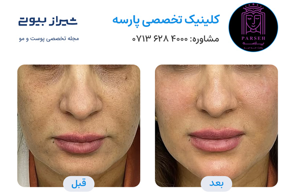 تزریق پروفایلو در شیراز - کلینیک پارسه