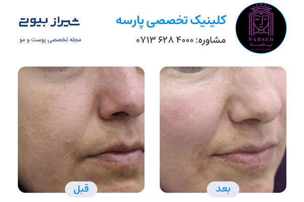 تزریق پروفایلو در شیراز - کلینیک پارسه