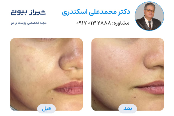تزریق پروفایلو در شیراز - دکتر محمد علی اسکندری