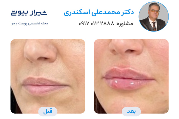 تزریق پروفایلو در شیراز - دکتر محمد علی اسکندری