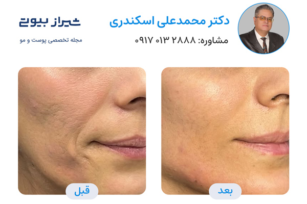 تزریق پروفایلو در شیراز - دکتر محمد علی اسکندری