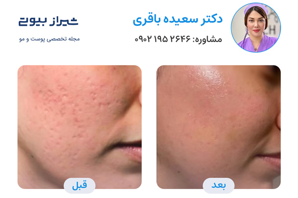 لیزر جای جوش در شیراز - دکتر سعیده باقری