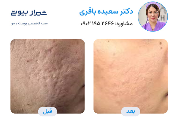 لیزر جای جوش در شیراز - دکتر سعیده باقری