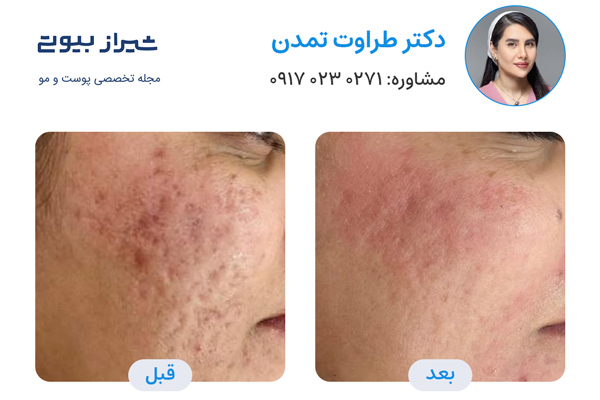 لیزر جای جوش در شیراز - دکتر طراوت تمدن