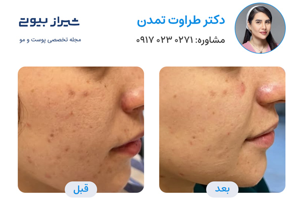 لیزر جای جوش در شیراز - دکتر طراوت تمدن