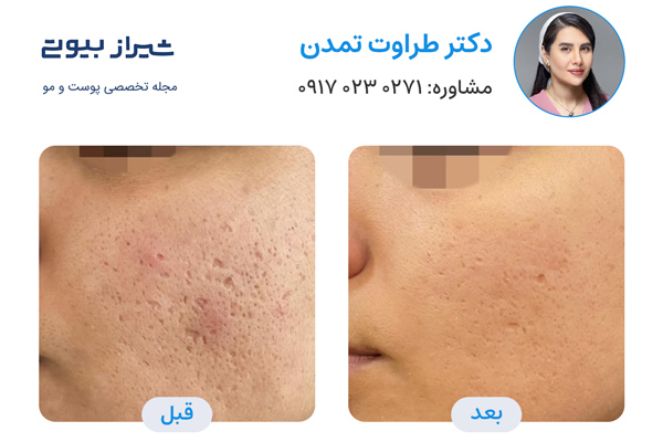 لیزر جای جوش در شیراز - دکتر طراوت تمدن