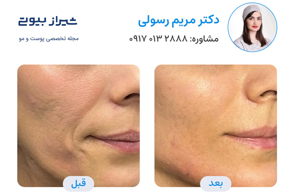 تزریق پروفایلو در شیراز - دکتر مریم رسولی