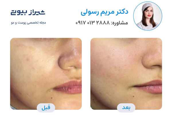 تزریق پروفایلو در شیراز - دکتر مریم رسولی