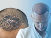 عفونت سر بعد از کاشت مو