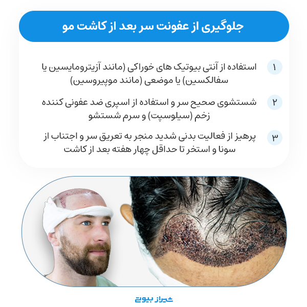 درمان عفونت سر بعد از کاشت مو
