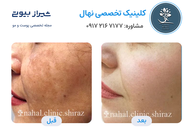 تصاویر قبل و بعد جوانسازی پوست در شیراز کلینیک نهال