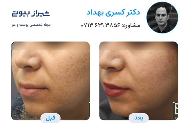 تصاویر قبل و بعد جوانسازی پوست در شیراز دکتر کسری بهداد