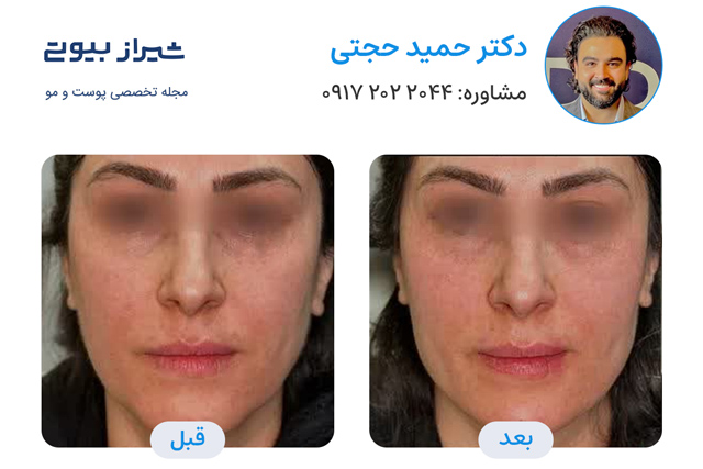 تصاویر قبل و بعد جوانسازی پوست در شیراز دکتر حمید حجتی
