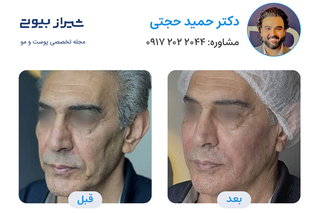 تصاویر قبل و بعد جوانسازی پوست در شیراز دکتر حمید حجتی