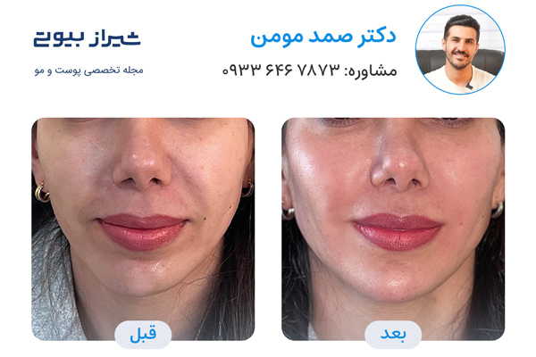جوانسازی پوست در شیراز - دکتر صمد مومن