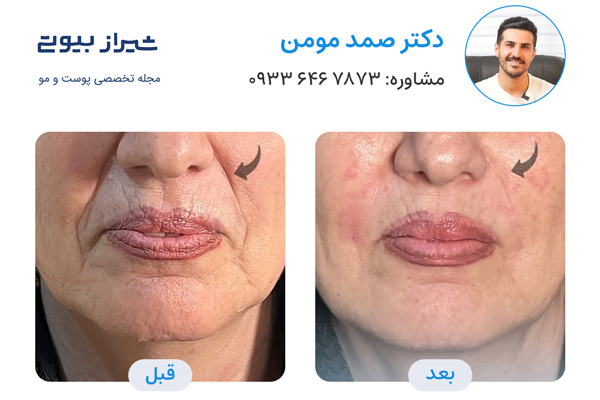 جوانسازی پوست در شیراز - دکتر صمد مومن