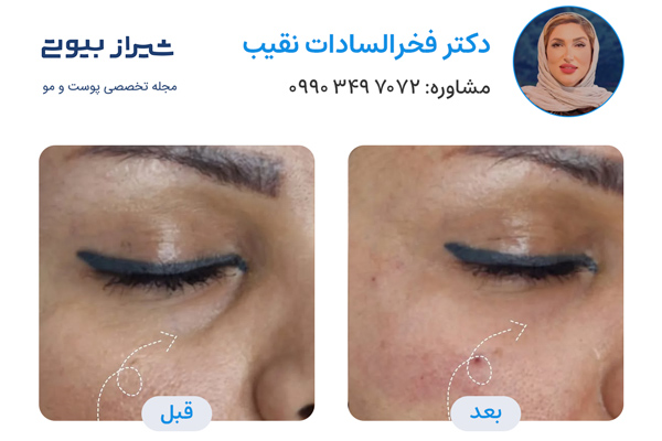 جوانسازی پوست در شیراز - دکتر فخرالسادات نقیب