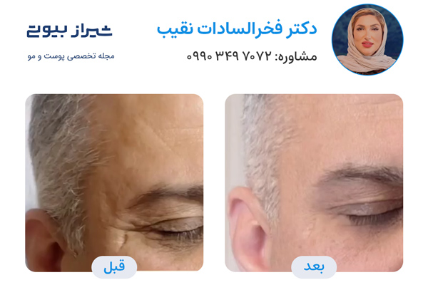 جوانسازی پوست در شیراز - دکتر فخرالسادات نقیب