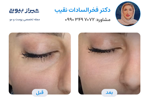 جوانسازی پوست در شیراز - دکتر فخرالسادات نقیب