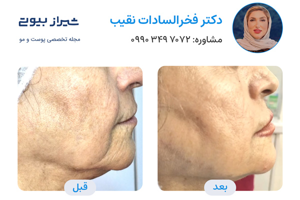 جوانسازی پوست در شیراز - دکتر فخرالسادات نقیب