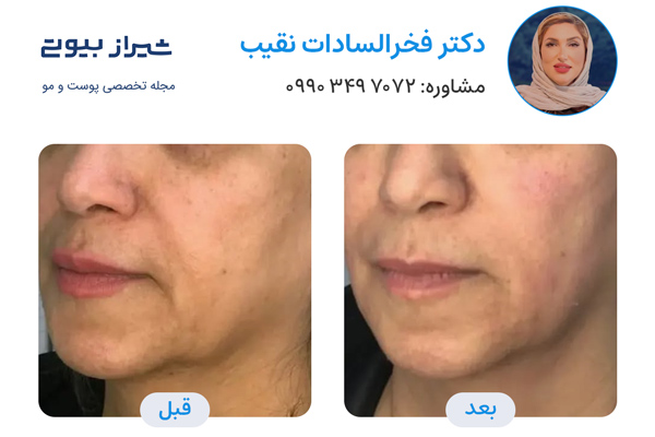 جوانسازی پوست در شیراز - دکتر فخرالسادات نقیب