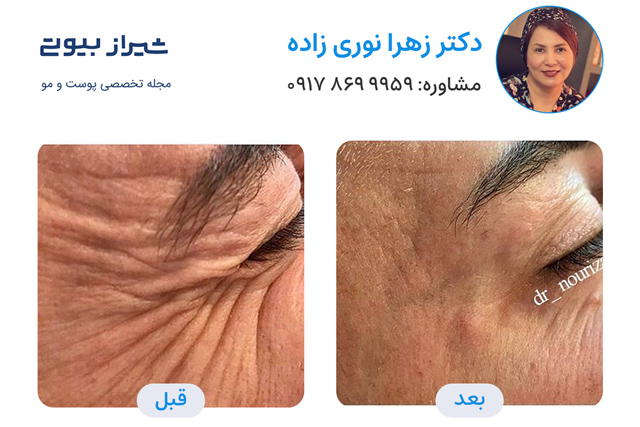 تصاویر قبل و بعد جوانسازی پوست در شیراز دکتر زهرا نوری زاده