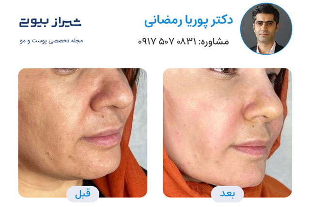 تصاویر قبل و بعد جوانسازی پوست در شیراز دکتر پوریا رمضانی