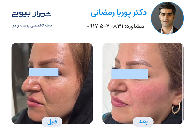 تصاویر قبل و بعد جوانسازی پوست در شیراز دکتر پوریا رمضانی
