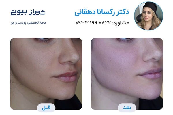 جوانسازی پوست در شیراز - دکتر رکسانا دهقانی