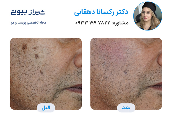 جوانسازی پوست در شیراز - دکتر رکسانا دهقانی