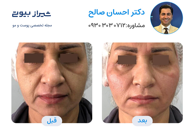 تصاویر قبل و بعد جوانسازی پوست در شیراز دکتر احسان صالح