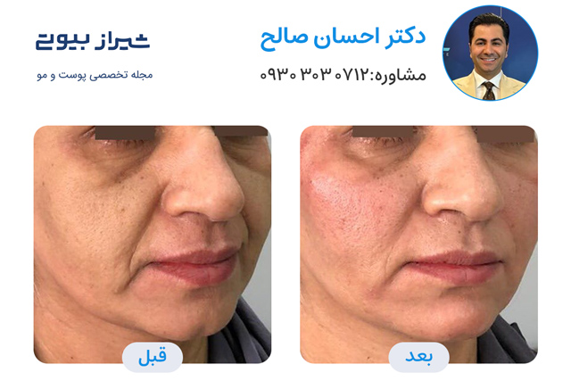 تصاویر قبل و بعد جوانسازی پوست در شیراز دکتر احسان صالح